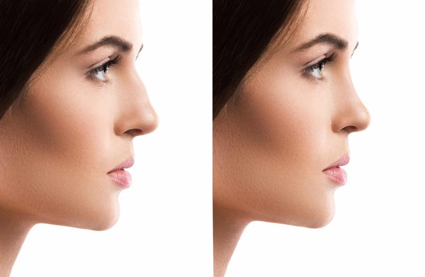 Les avantages de la rhinoplastie ultrasonique par rapport aux techniques traditionnelles